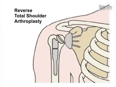 Reverse Total Shoulder Arthroplasty
