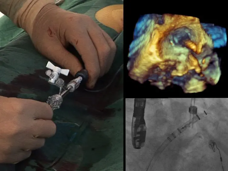 Catheter Ablation in Combination With Left Atrial Appendage Closure for Atrial Fibrillation