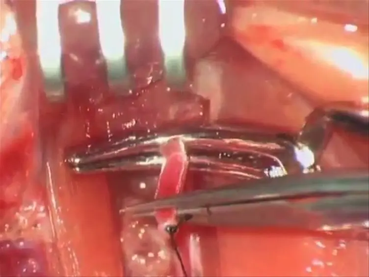 Training a Sophisticated Microsurgical Technique: Interposition of External Jugular Vein Graft in the Common Carotid Artery in Rats