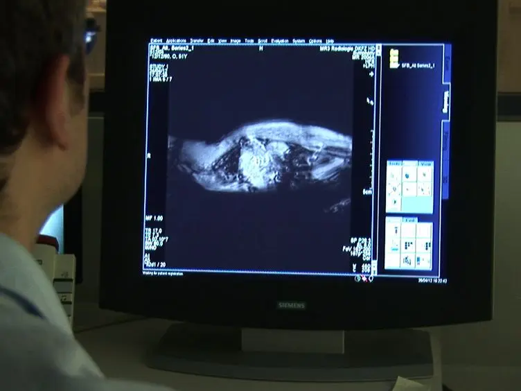 Multi-modal Imaging of Angiogenesis in a Nude Rat Model of Breast Cancer Bone Metastasis Using Magnetic Resonance Imaging, Volumetric Computed Tomography and Ultrasound