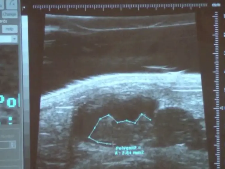 An Orthotopic Bladder Tumor Model and the Evaluation of Intravesical saRNA Treatment
