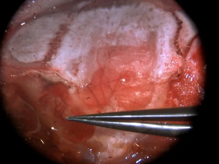 Permanent Cerebral Vessel Occlusion <em>via</em> Double Ligature and Transection