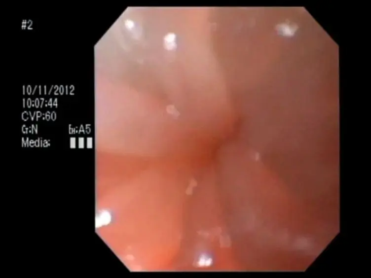Flexible Colonoscopy in Mice to Evaluate the Severity of Colitis and Colorectal Tumors Using a Validated Endoscopic Scoring System