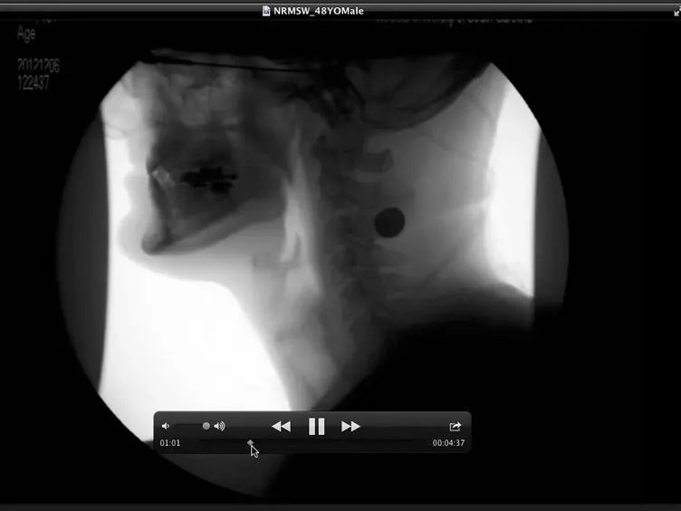 Coordinate Mapping of Hyolaryngeal Mechanics in Swallowing