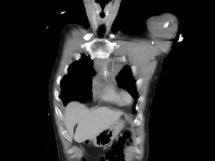 Surgical Fixation of Sternal Fractures: Preoperative Planning and a Safe Surgical Technique Using Locked Titanium Plates and Depth Limited Drilling