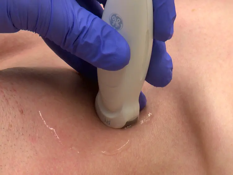 The Supraclavicular Fossa Ultrasound View for Central Venous Catheter Placement and Catheter Change Over Guidewire