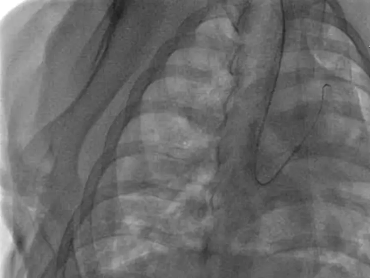 Increasing Pulmonary Artery Pulsatile Flow Improves Hypoxic Pulmonary Hypertension in Piglets