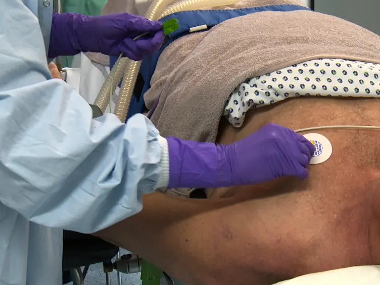 Drug-Induced Sleep Endoscopy (DISE) with Target Controlled Infusion (TCI) and Bispectral Analysis in Obstructive Sleep Apnea
