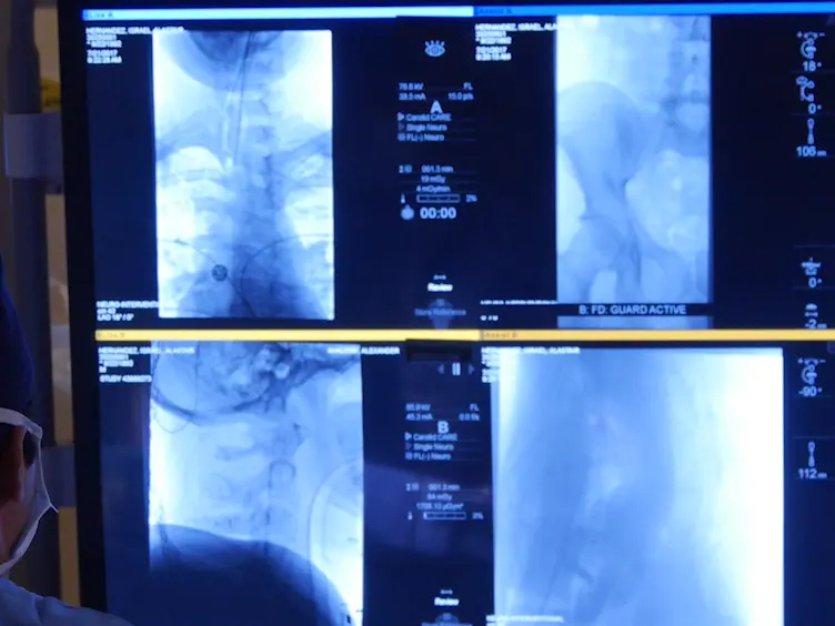 Comprehensive Endovascular and Open Surgical Management of Cerebral Arteriovenous Malformations
