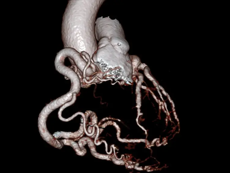 Direct Re-implantation of Left Coronary Artery into the Aorta in Adults with Anomalous Origin of Left Coronary Artery from the Pulmonary Artery (ALCAPA)