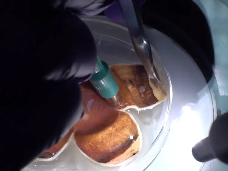 Dissection of Human Retina and RPE-Choroid for Proteomic Analysis
