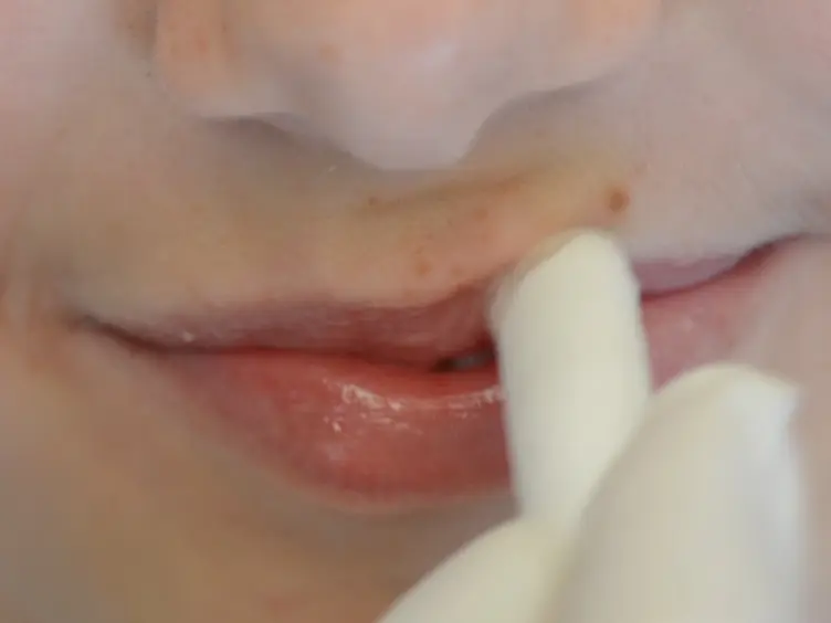 Oral Biofilm Sampling for Microbiome Analysis in Healthy Children