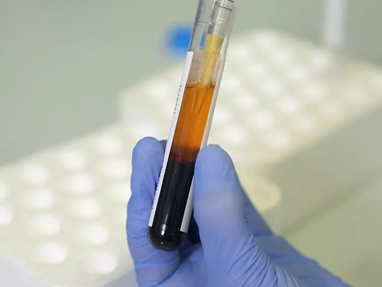 MicroRNA Based Liquid Biopsy: The Experience of the Plasma miRNA Signature Classifier (MSC) for Lung Cancer Screening