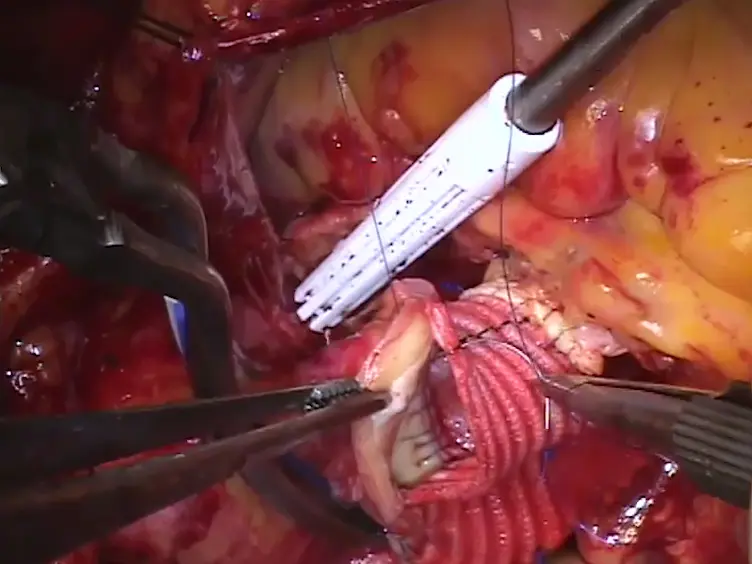 Standardized Technique of Aortic Valve Re-implantation for Valve-sparing Aortic Root Replacement