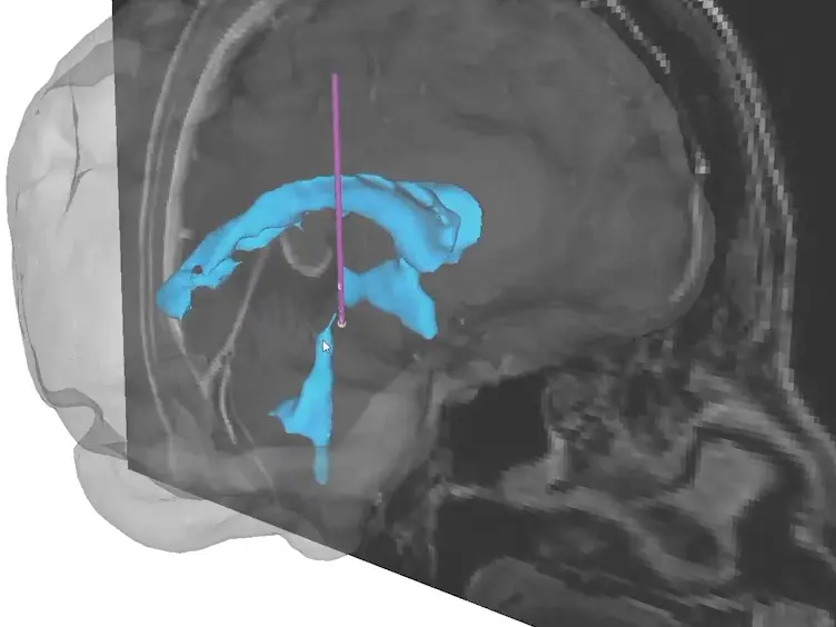 Targeting Neuronal Fiber Tracts for Deep Brain Stimulation Therapy Using Interactive, Patient-Specific Models