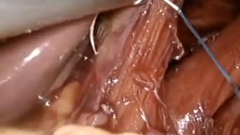 Laparoscopic Repair of Para-Esophageal Hernia Using Absorbable Biosynthetic Mesh