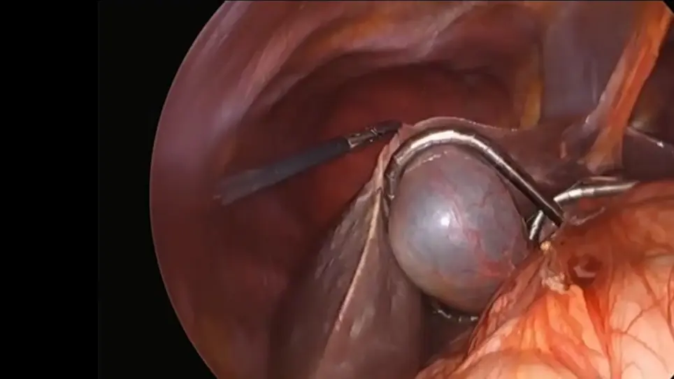Technical Detail for Robot Assisted Pancreaticoduodenectomy