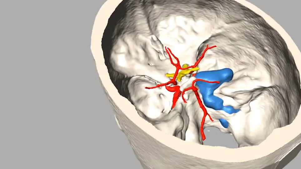 Multicolor 3D Printing of Complex Intracranial Tumors in Neurosurgery