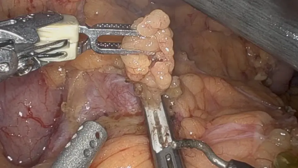 Robot Assisted Distal Pancreatectomy with Celiac Axis Resection (DP-CAR) for Pancreatic Cancer: Surgical Planning and Technique