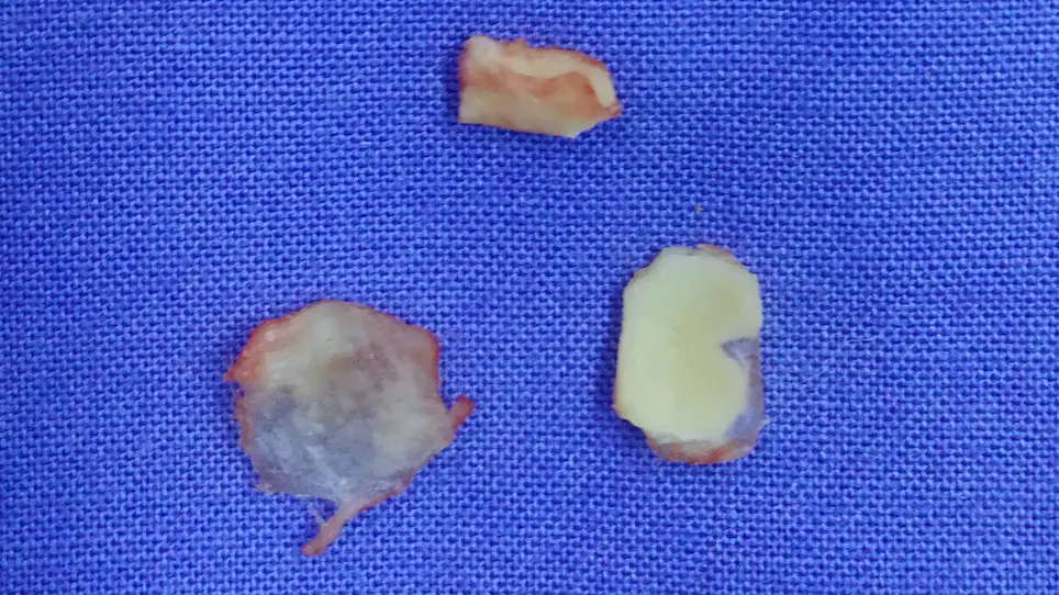 Endaural Endoscopic Atticoantrotomy (Retrograde Mastoidectomy) using a Constant Suction Bone-drilling Technique