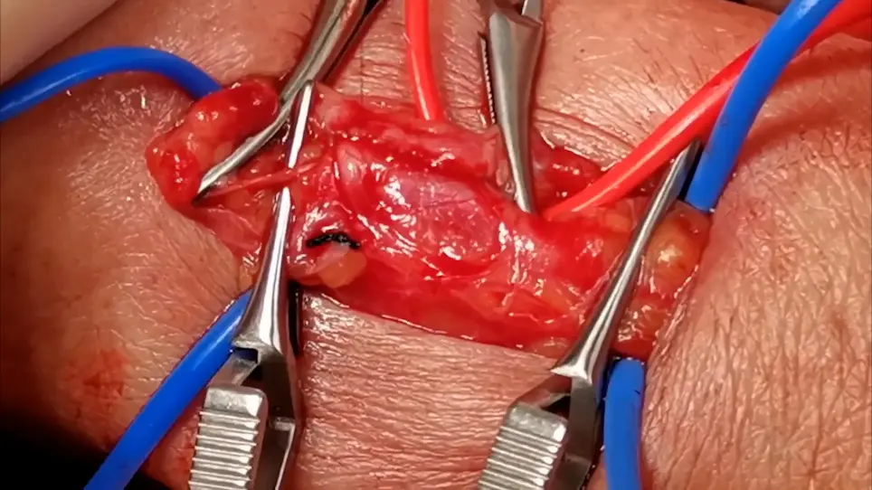 Creating Radio-cephalic Arteriovenous Fistula in the Forearm with a Modified No-Touch Technique