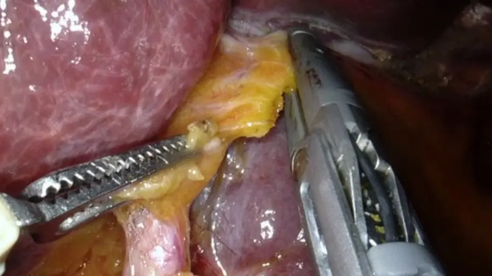 Robotic Left Hepatectomy using Indocyanine Green Fluorescence Imaging for an Intrahepatic Complex Biliary Cyst