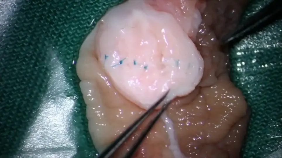Microscopic Replantation of Penile Glans Amputation Due to Circumcision