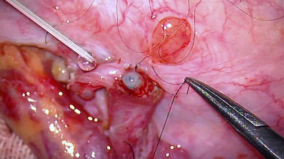 A Modified Vessel-Sparing Microsurgical Vasoepididymostomy