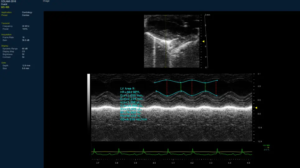 Investigating the Pathogenesis of MYH7 Mutation Gly823Glu in Familial Hypertrophic Cardiomyopathy using a Mouse Model