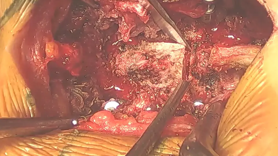 Laminectomy for the Removal of Thoracic Ossification of the Ligamentum Flavum (TOLF) Using Ultrasonic and Conventional Osteotomes