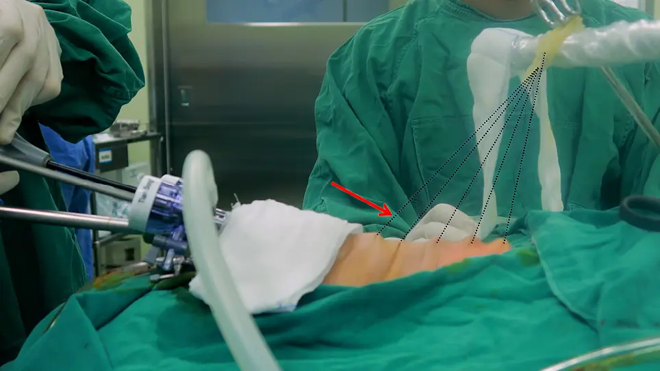 Transoral Endoscopic Thyroidectomy Vestibular Approach for Thyroid Lobectomy