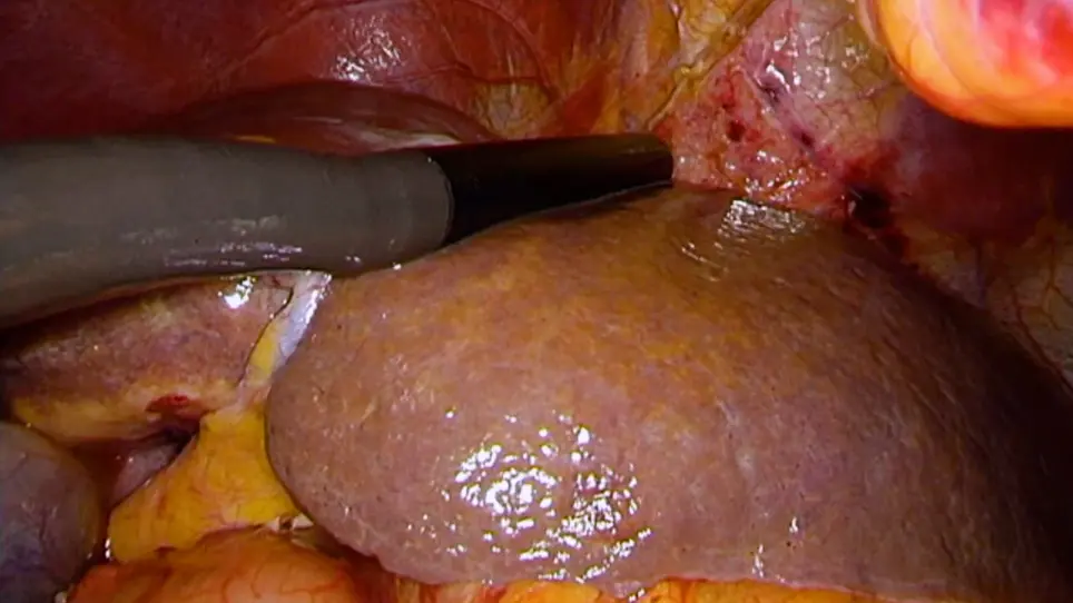 Application of the En Bloc Concept Combined with Anatomic Resection in Laparoscopic Hepatectomy