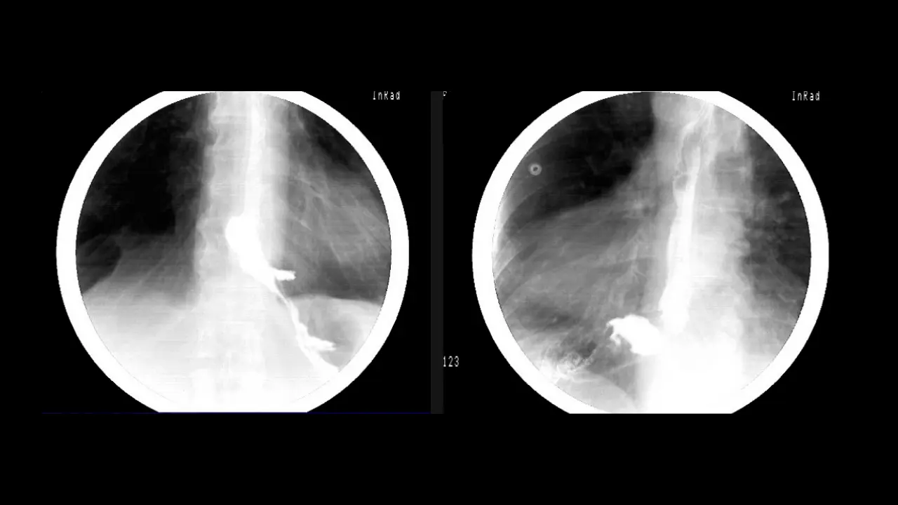 Robotic Myotomy and Partial Fundoplication for Achalasia