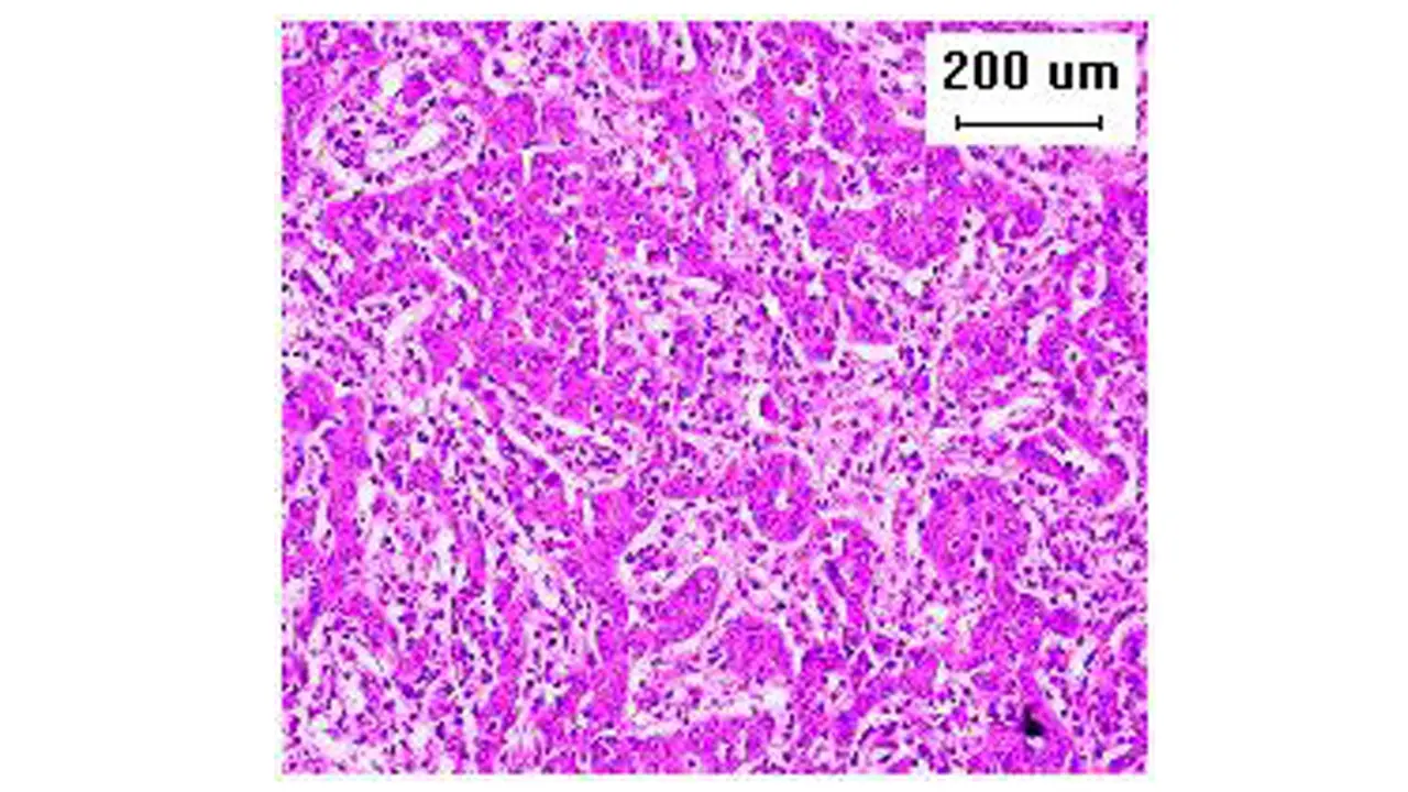 Fluorescent Laparoscopic Central Hepatectomy for Liver Cancer Using Indocyanine Green Negative Staining