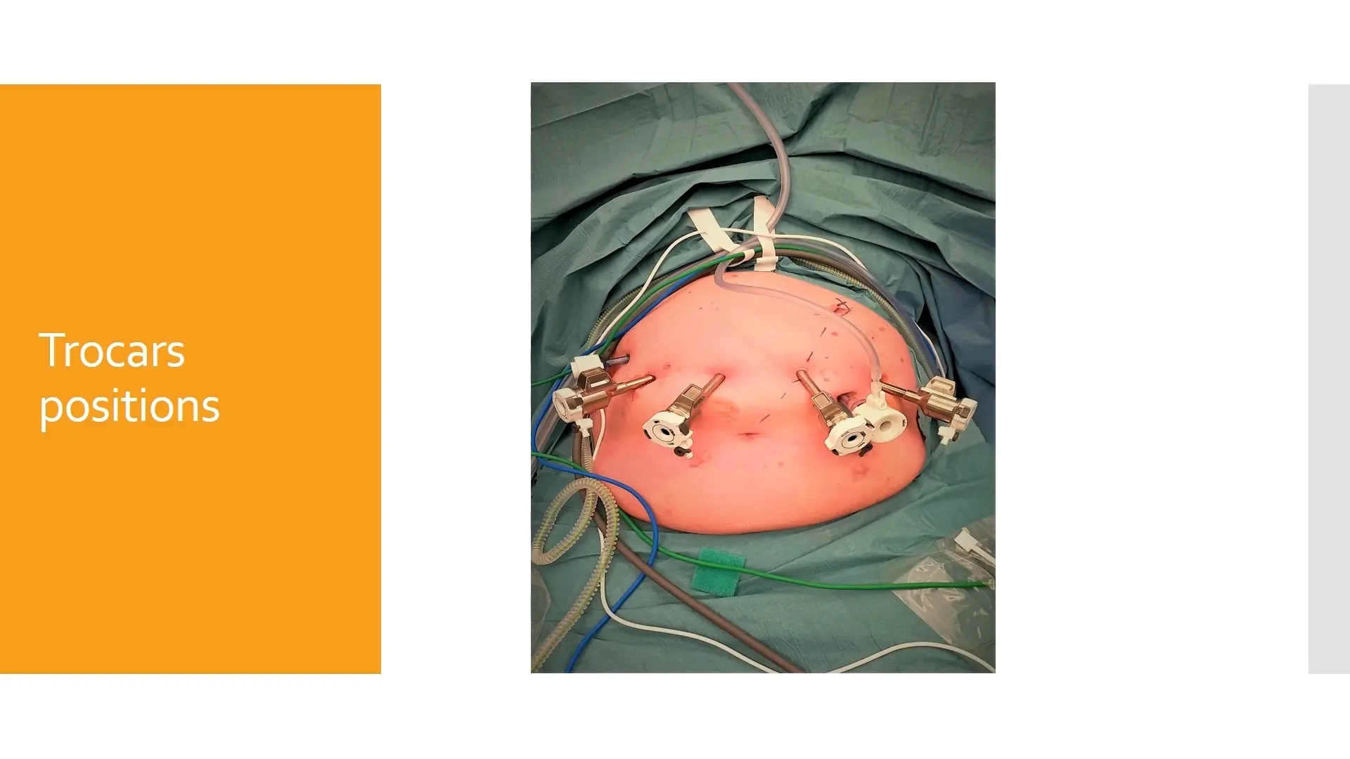 Robotic Spleen-Preserving Distal Pancreatectomy: The Warshaw and Kimura Techniques