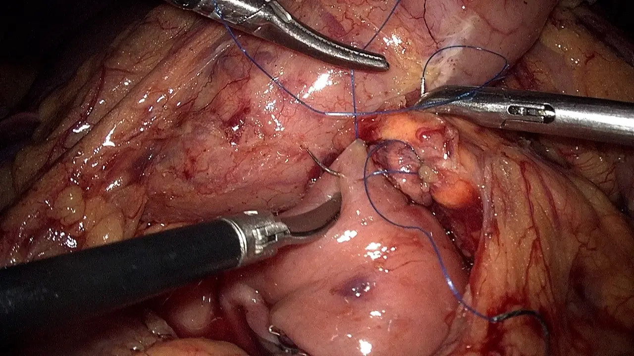 Laparoscopic Duodenum-Preserving Pancreatic Head Resection via Inferior Infracolic Approach: A Surgical Approach for Benign Lesions