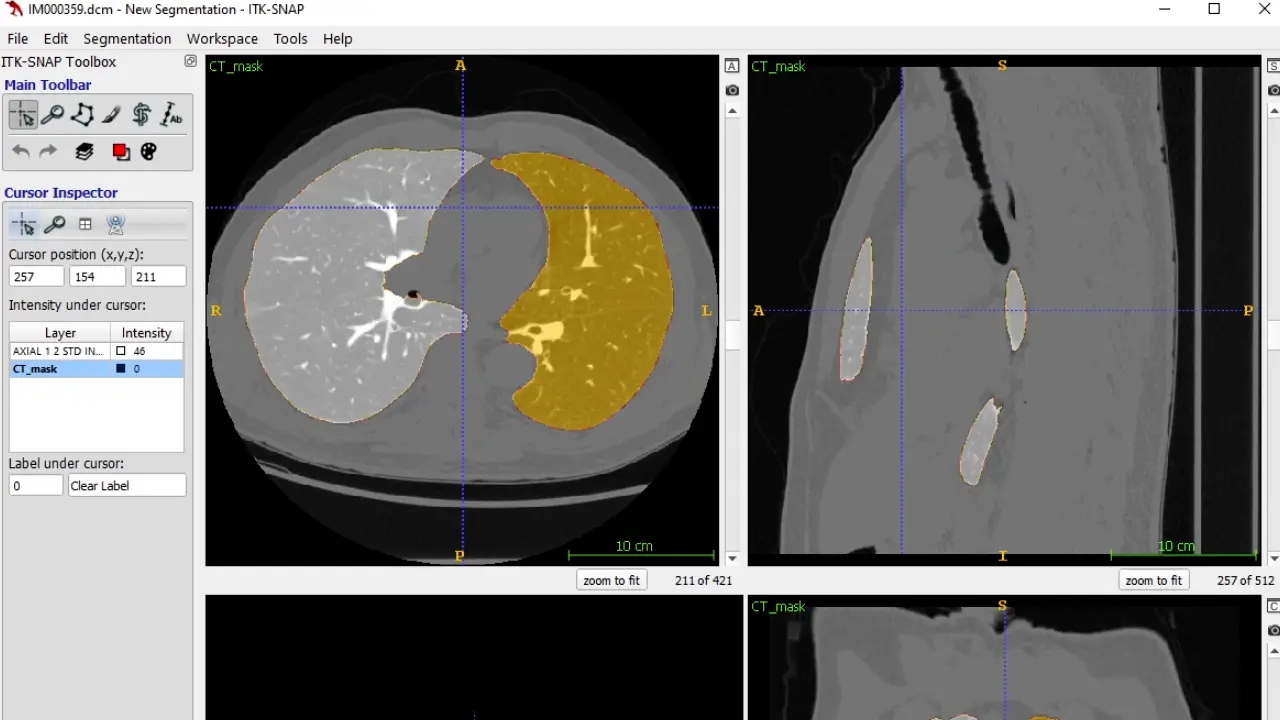 Multi-modal Pulmonary Imaging: Using Complementary Information from CT and Hyperpolarized <sup>129</sup>Xe MRI to Evaluate Lung Structure-Function