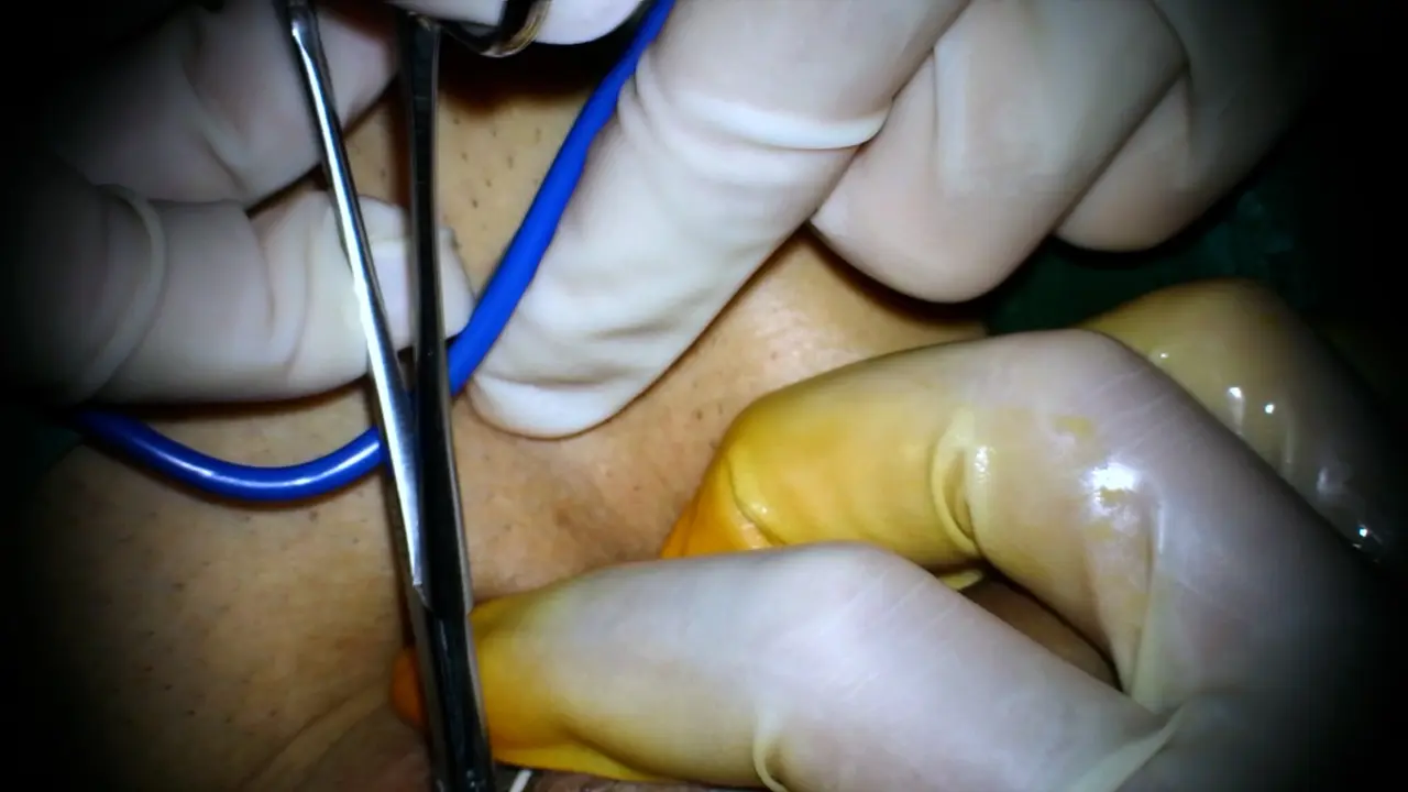 Microscopic Electric Rotary Grinding of Plaques Combined with Graft Repair in the Management of Peyronie's Disease