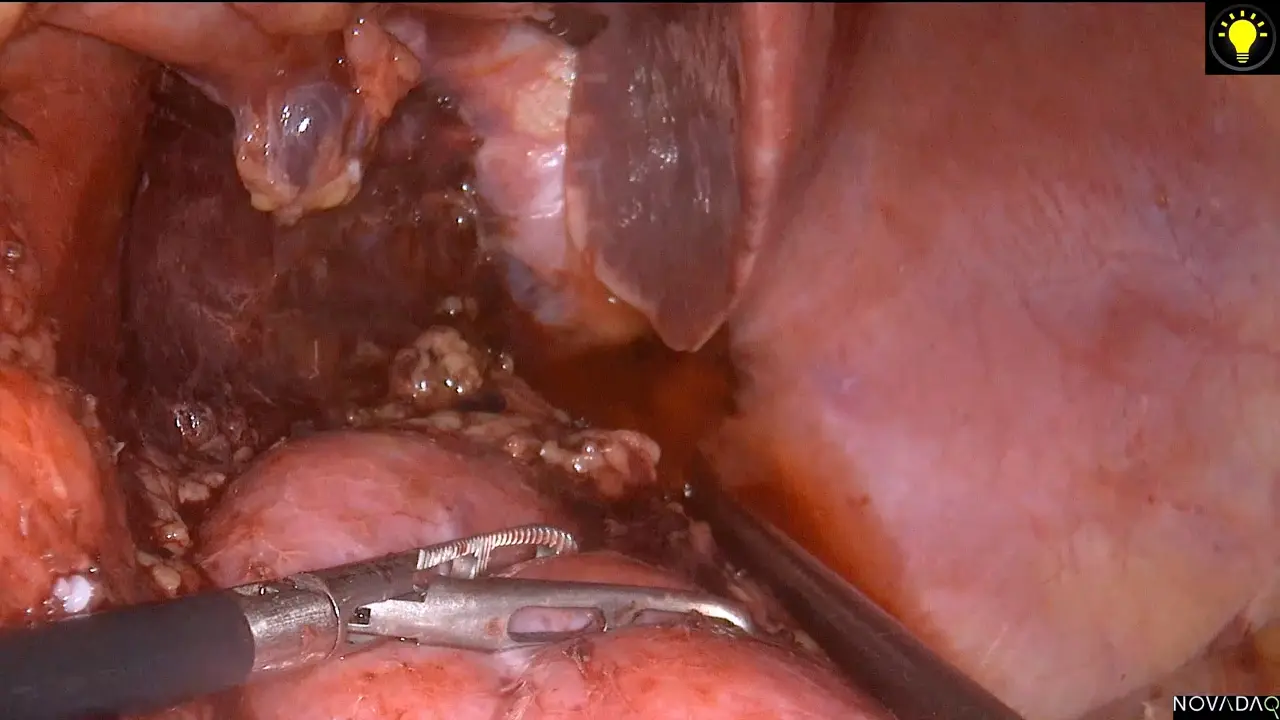 Laparoscopic Posterior Radical Antegrade Modular Pancreatosplenectomy for Distal Pancreatic Carcinoma