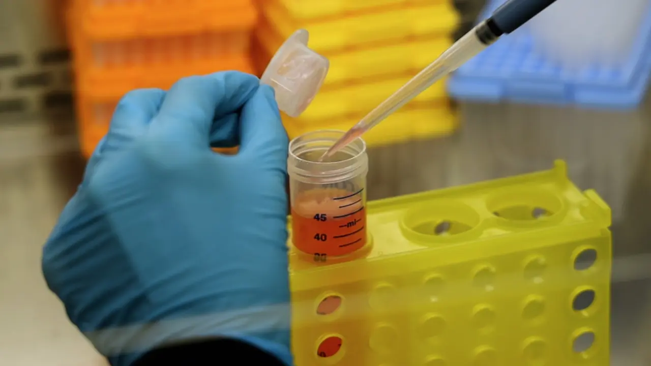 Unveiling Therapeutic Opportunities with Melanoma Patient-derived Organoid Models