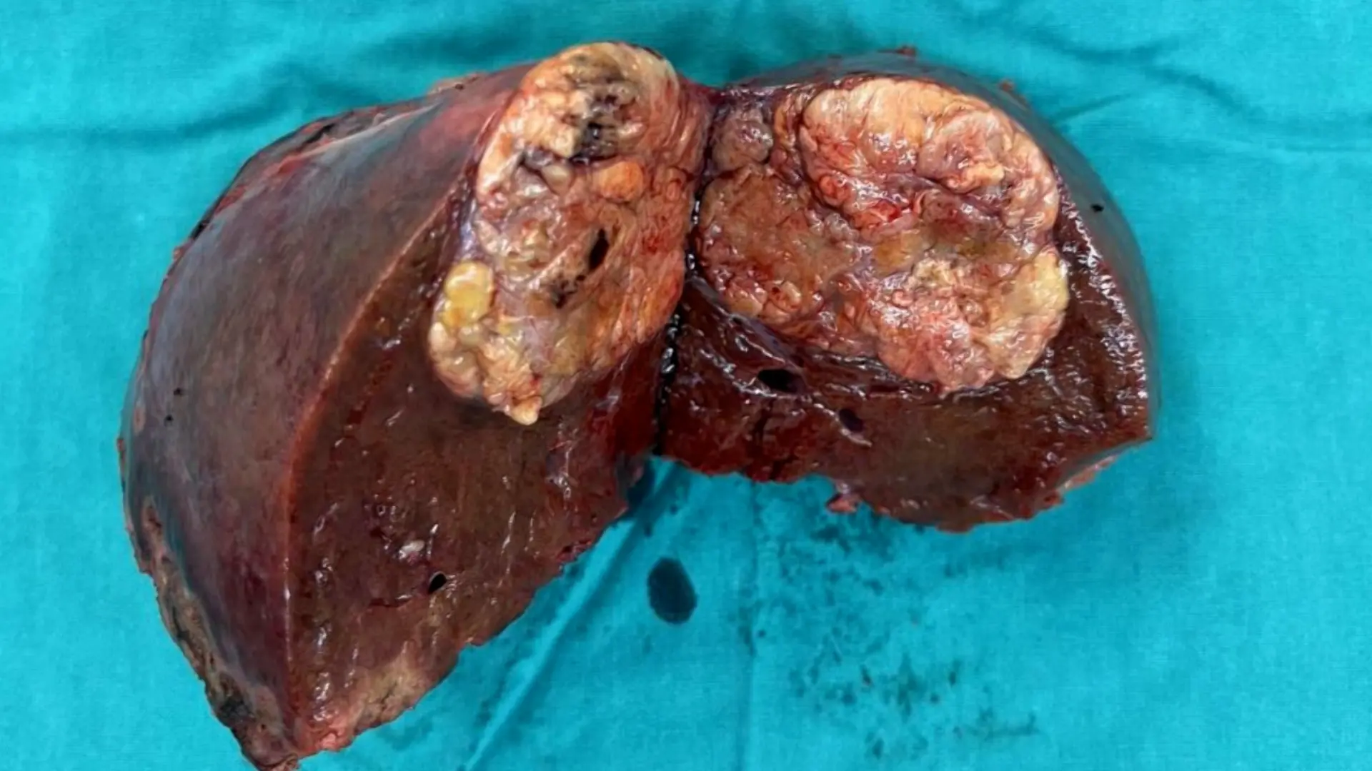 Laparoscopic Anatomical Liver Segment VII Resection with Liver Parenchymal Transection Following a Priority Approach