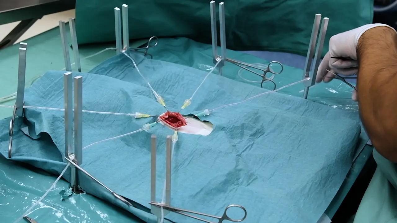 5/6 Nephrectomy Using Sharp Bipolectomy Via Midline Laparotomy in Rats