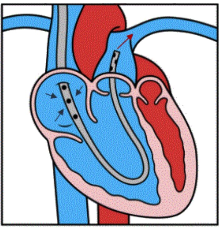 Heart catheter diagram showing blood flow and insertion path via veins for diagnostic purposes.
