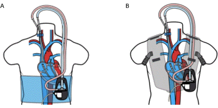 Cardiovascular bypass diagram; A and B methods, heart-lung machine circuit, blood oxygenation.