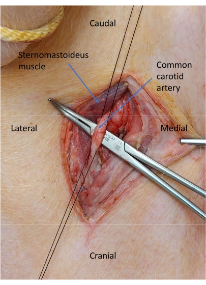 Surgical dissection diagram; showing sternomastoid muscle, common carotid artery; labeled anatomy.