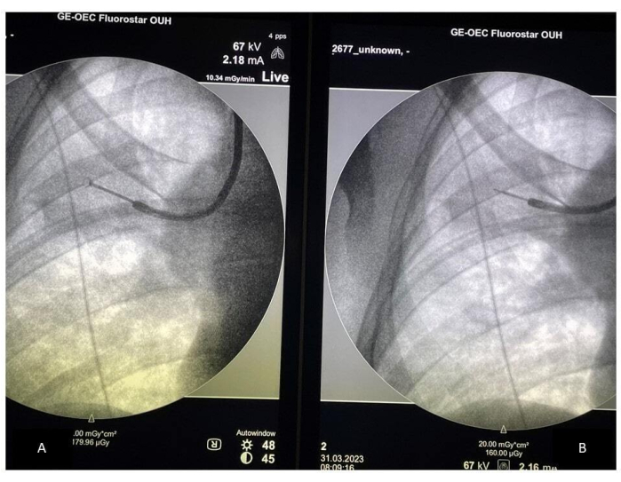 Fluoroscopy of vascular access, comparison image, medical imaging technique, catheter placement.