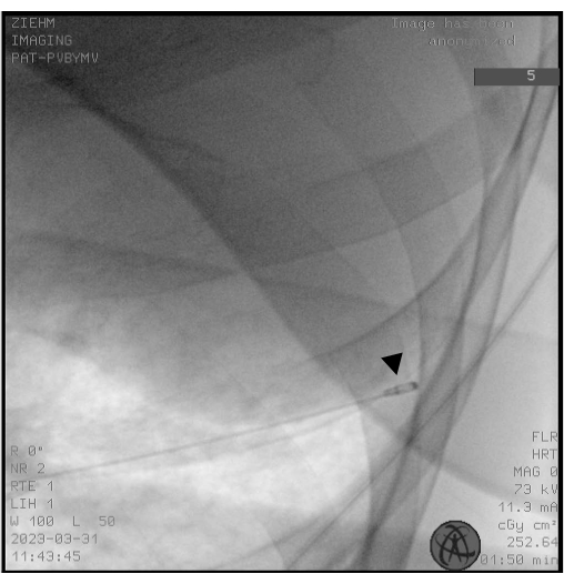 Fluoroscopy image showcasing vascular catheter placement procedure for real-time clinical analysis.